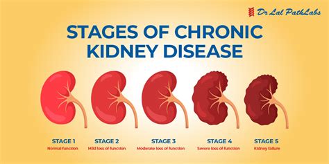 chronic kidney disease near occidental|Chronic kidney disease on the rise, health experts warn.